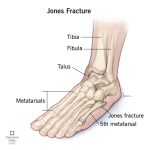 Foot Fractures Explained: Symptoms, Treatment & Recovery