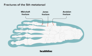 Foot Fractures Explained: Symptoms, Treatment & Recovery