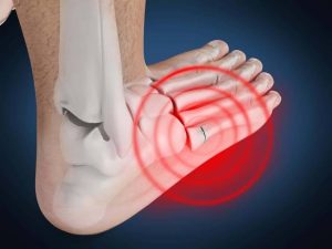 How Are Foot Fractures Treated? Understanding Your Options
