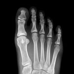 How Long Does a Foot Fracture Take to Heal?