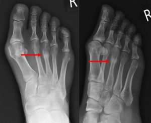 Fracture Take to Heal?