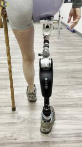 How Much Do Microprocessor Knees and Feet Cost?