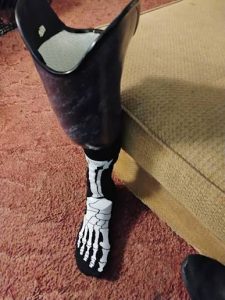 Microprocessor Foot vs. Traditional Prosthetic Foot: Key Differences