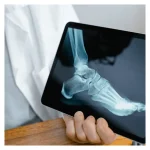 Non-Surgical vs. Surgical Treatment for Foot Fractures