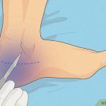 When to See a Doctor for a Foot Fracture