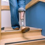 From Fracture to Recovery: A Guide for Prosthetic Limb Users