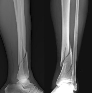 How to Safely Return to Walking After a Leg Fracture