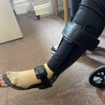 When Do Stroke Survivors Need an Orthosis?