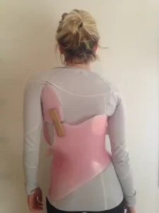 When Might You Need a Spinal Brace?