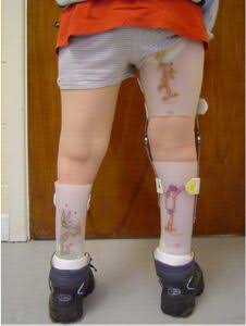 What Is a KAFO? Understanding Knee-Ankle-Foot Orthoses